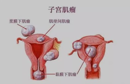 子宫肌瘤和怀孕那些事儿