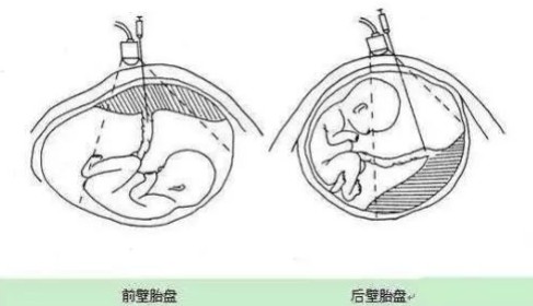 怀孕胎盘前壁好还是后壁好些呢？